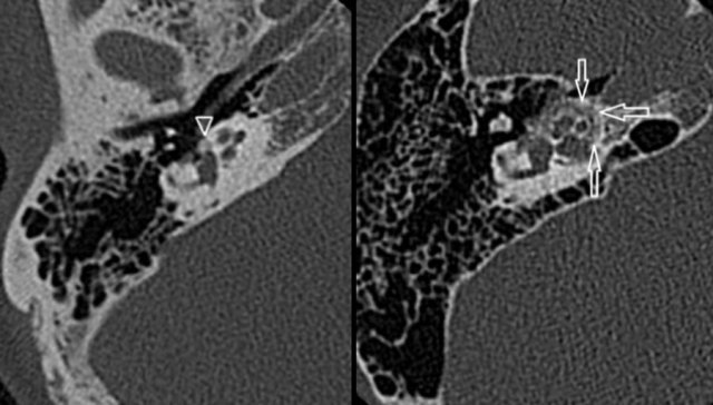 Otosclerosis: hypoattenuated bone in the region of the fissula ante fenestram in fenestral otosclerosis (left). Cochlear otosclerosis appears as a hypoattenuated halo surrounding the cochlea on CT (right).