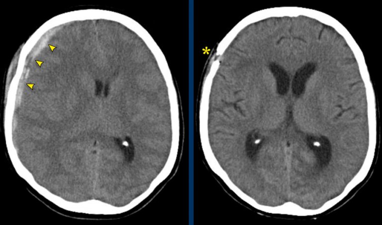 The Radiology Assistant : Traumatic Intracranial Hemorrhage