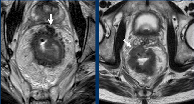 Two examples of T3 tumors with invasion of the mesorectal fascia. In the left case the distance between the tumor and the MRF is less than 1 mm at 12 o’clock. In the right case there is more extensive involvement of the MRF between 10 and 12 o’clock