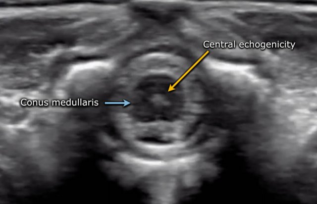 The Radiology Assistant : Ultrasound of the Neonatal spine