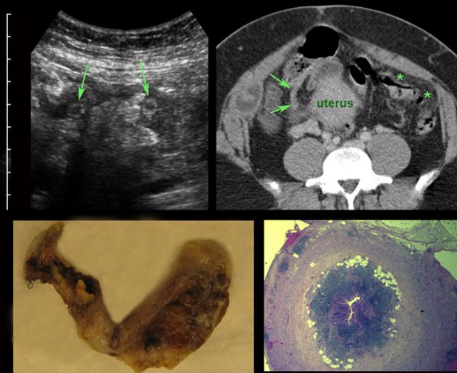 Confusing peri-appendicitis in PID, leading to unnecessary appendectomy.