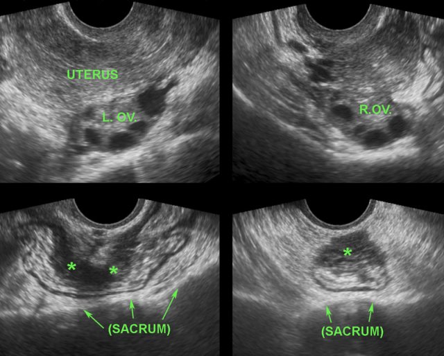 abnormal transvaginal ultrasound