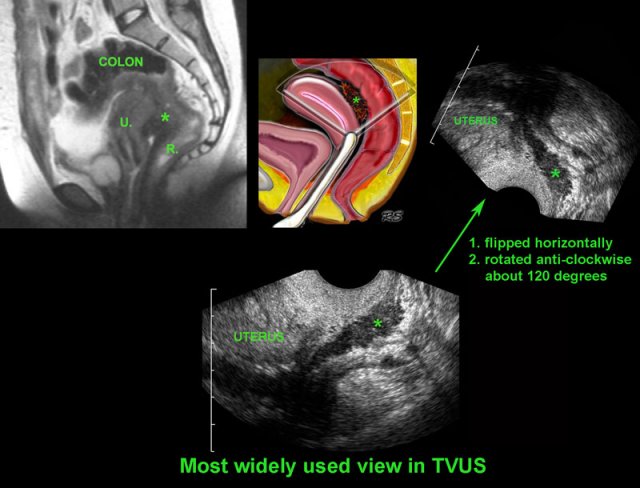 Image orientation in TVUS and MRI