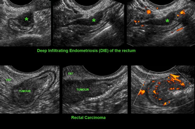 Endometriosis Transvaginal Ultrasound