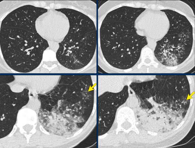 The Radiology Assistant : COVID-19 CO-RADS classification