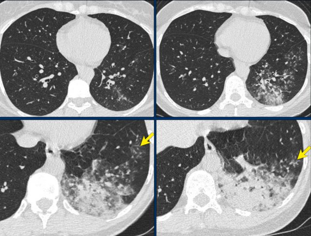 CO-RADS 2. Bacterial pneumonia with endobronchial spread (tree-in-bud)