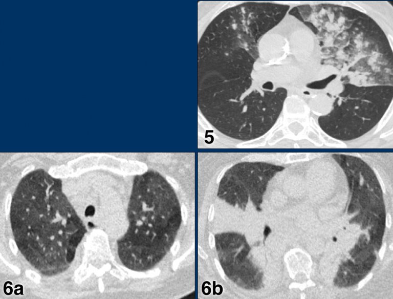 The Radiology Assistant : COVID-19 CO-RADS classification