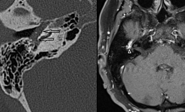 Paraganglioma: soft tissue mass in the middle ear (left), strong enhancement of the lesion (right)