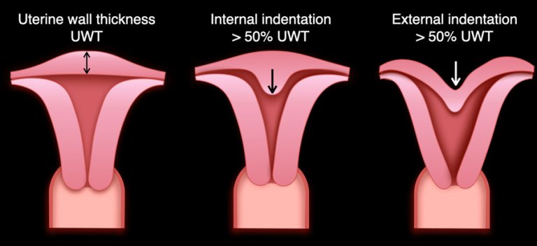 The Radiology Assistant : Müllerian duct anomalies