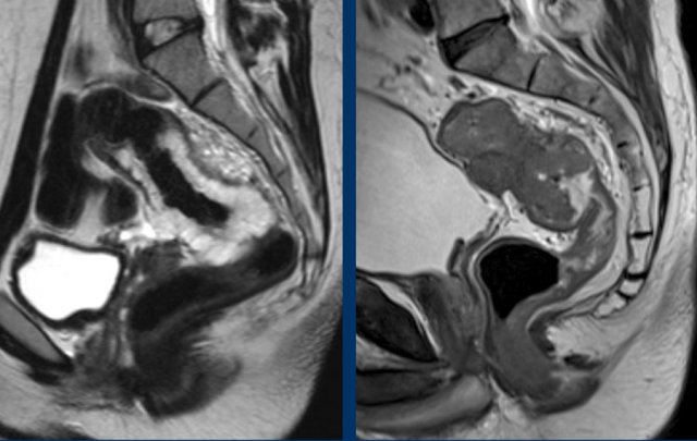 Bright mucinous tumor versus solid tumor with intermediate signal.