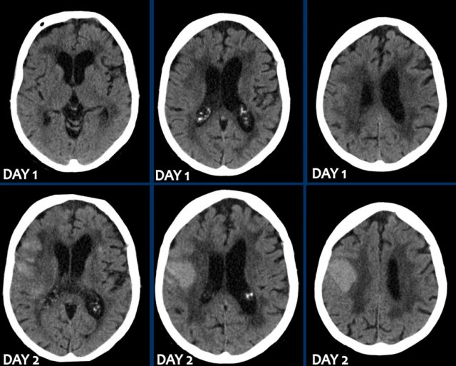 intraparenchymal hemorrhage