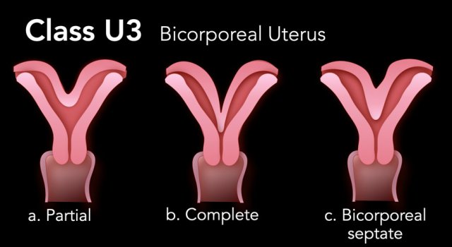 Bicornuate Uterus Radiology Pin Page Bicornuate Uterus Radiology Pin Page