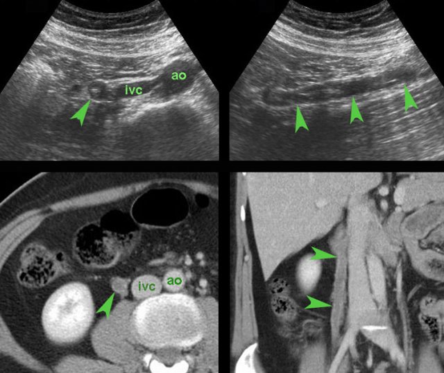 Right ovarian vein thrombosis in patient after hysteroscopic myomectomy.