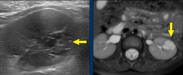 Cystic nephroma