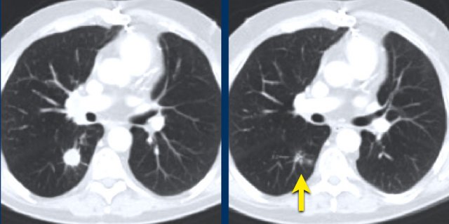 At follow up the lung metastasis is too small to measure. A default value of 5mm is assigned.