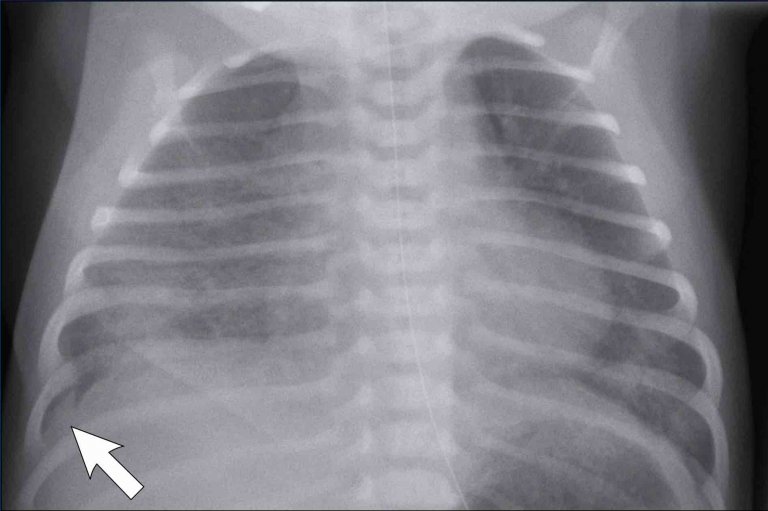 The Radiology Assistant : Neonatal Chest