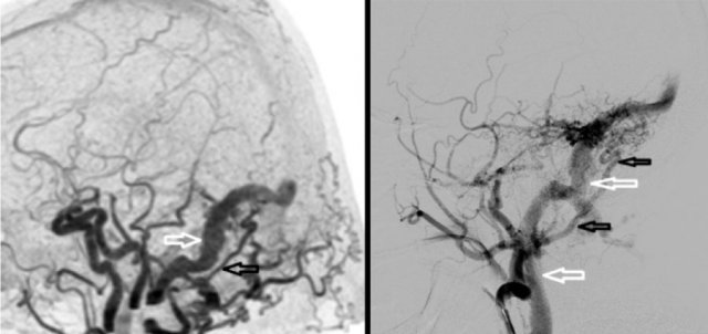 AVF: abnormal early contrast filling of the sigmoid sinus (left), venous drainage of the sigmoid sinus into the jugular vein (right)