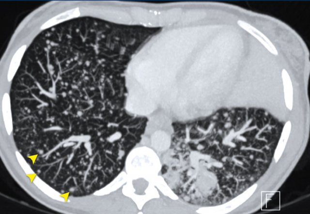 Non-target lesions: miliary lung metastases of ovarian cancer.
