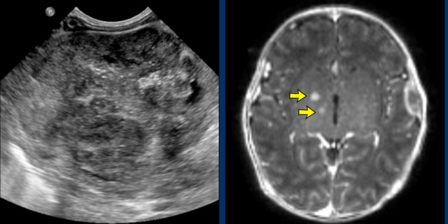 Malignant rhabdoid tumor of the kidney with brain (arrows) and bone metastases