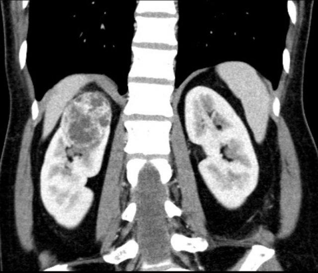 Solid renal tumor with small cystic or necrotic components