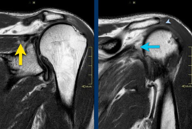 Mri Rotator Cuff Tendinitis The Radiology Assistant Shoulder Rotator