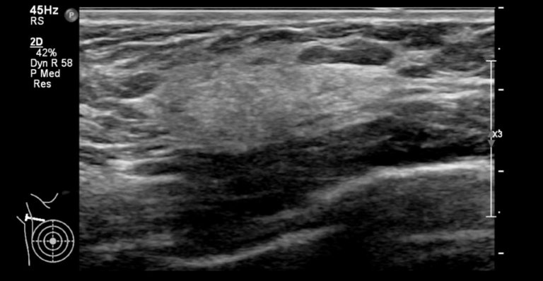 The Radiology Assistant : Ultrasound Of The Breast