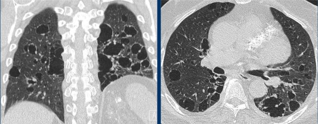 Light chain deposition disease