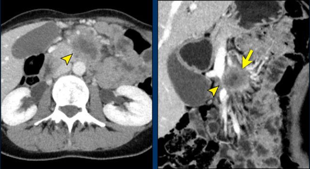 Axial CT shows a mass in the uncinate process (arrowhead).  The coronal reformat shows invasion of the mesentery as demonstrated by encasement of a major SMV tributary (arrowhead) and separate obstruction of proximal jejunal veins (arrow)