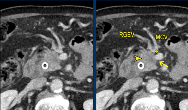 Axial CT shows a mass in the pancreatic head (arrowhead). In less then 90 degrees contact with the SMV (arrow), but also in close contact to the gastrocolic trunk (asterisk), in this case the venous confluence of the right gastopepiploic vein (RGEV) and the middle colic vein (MCV).