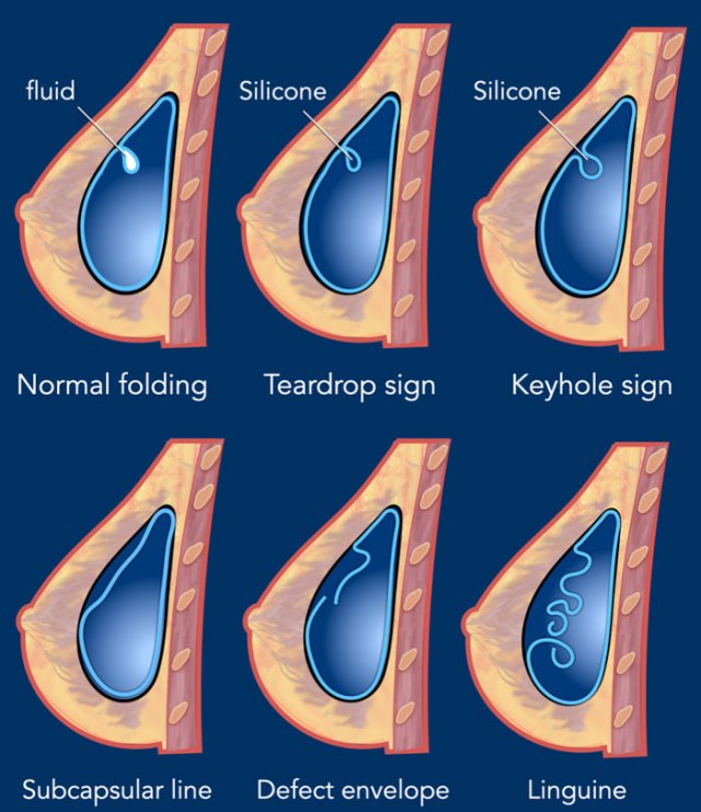 Round & Teardrop Breast Implant Differences