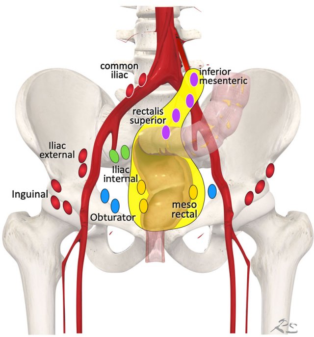 Regional lymph node drainage. The lymph nodes in red are all non, regional (M-stage) nodes. In TME only the mesorectal nodes and in high rectal tumors also the rectalis superior and inferior mesenteric nodes are excised.