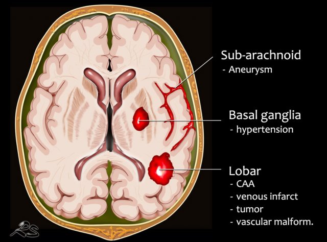 The subarachnoid hemorrhage (SAH) stages. The yellow arrows