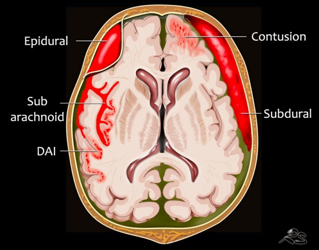 brain hemorrhage diagram