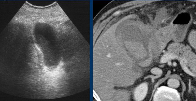 Hemorrhagic cholecystitis. US only shows a sludge-like mass.  CT scan demonstrates hyperdense blood within the lumen and an irregular wall. Cholecystectomy was technically very difficult.