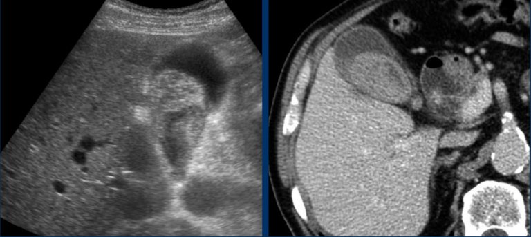 The Radiology Assistant : Gallbladder Obstruction