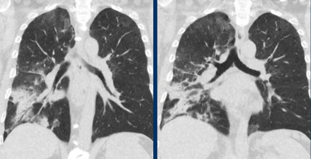 Stationary groundglass and consolidations in the right lung after radiation therapy