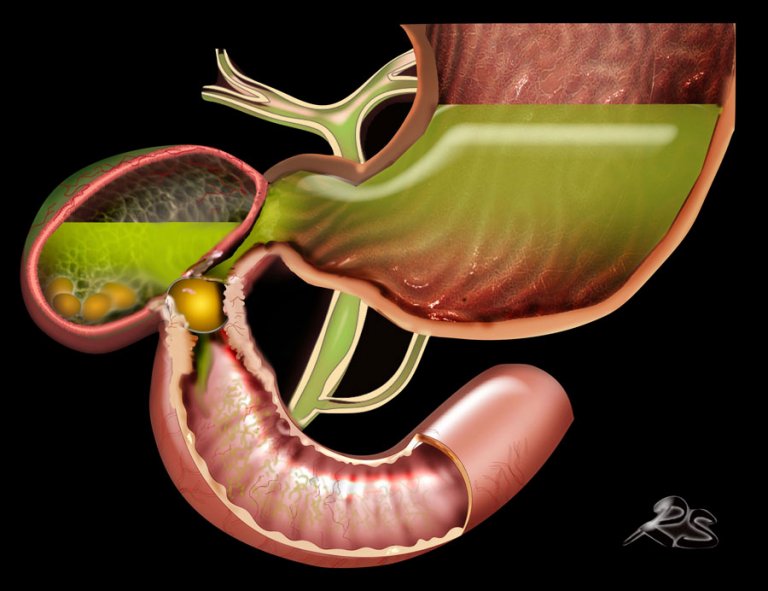 The Radiology Assistant : Gallbladder obstruction