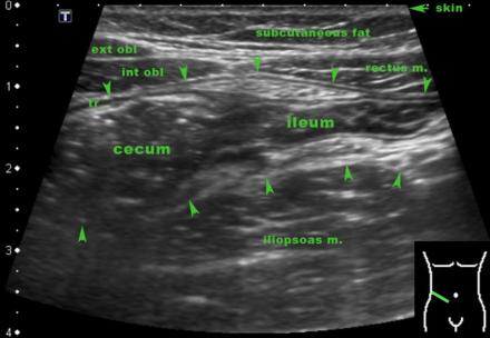 The Radiology Assistant : Ultrasound of the GI tract - Normal Anatomy