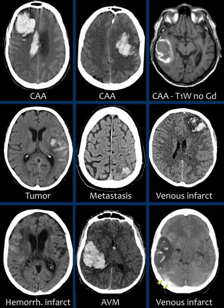 The Radiology Assistant : Nontraumatic Intracranial Hemorrhage