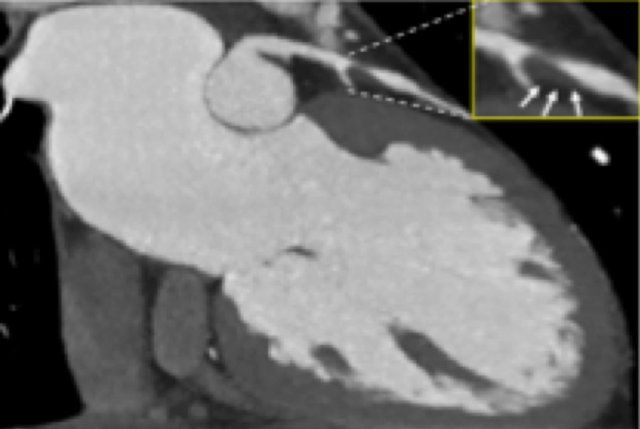 Low-attenuation plaque (HU=14) with severe (70-99%) stenosis in the LAD.