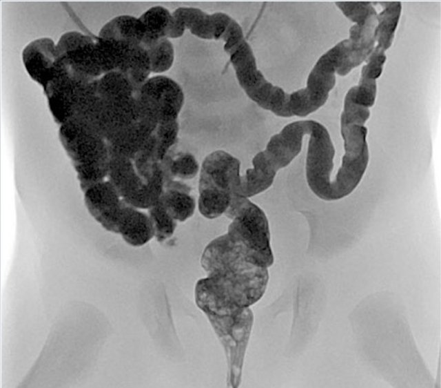 Microcolon: elongated colon with smalldiameter.  It indicates that meconium has not reached the colon yet. Once the obstruction is relieved and bowel contents pass through the colon, the colon will develop normally without remaining consequences.