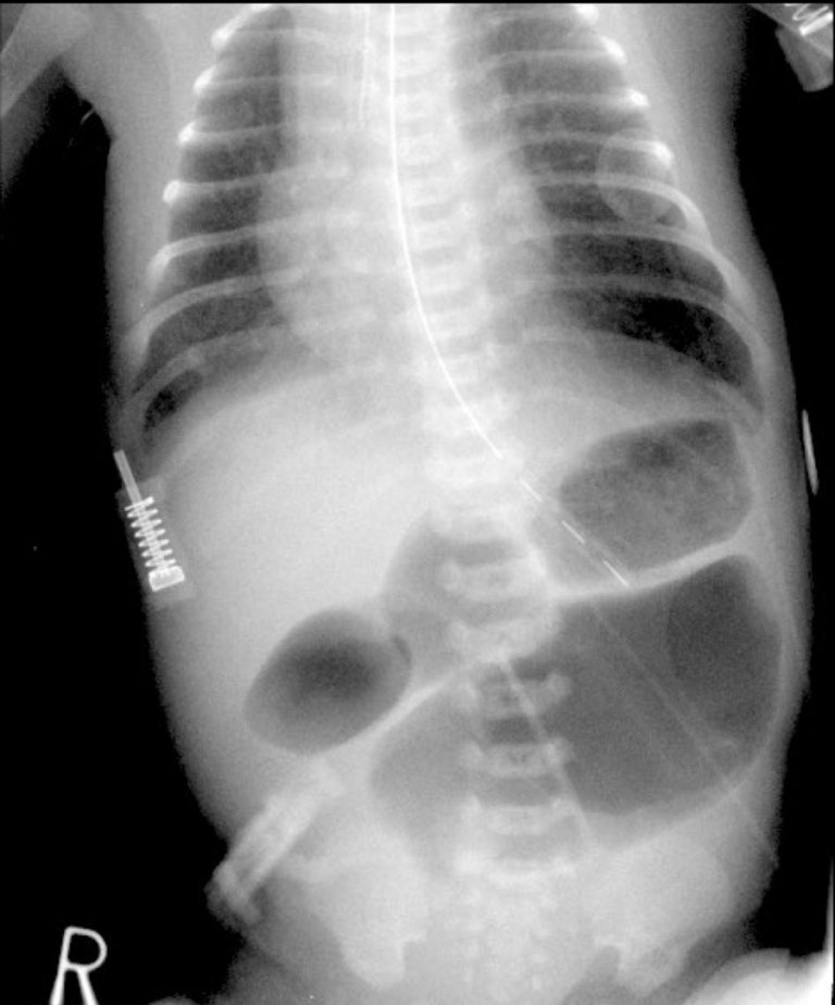 The Radiology Assistant : Acute Abdomen in Neonates