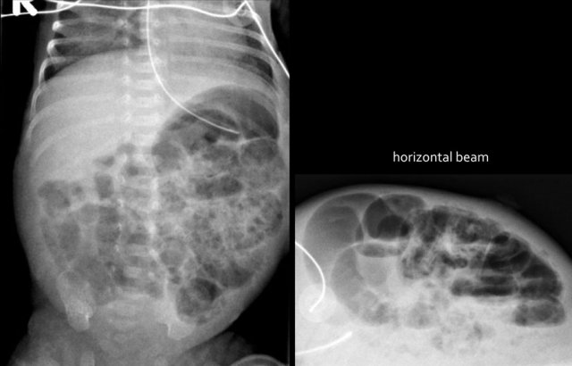 Pneumatosis intestinalis in a child with NEC