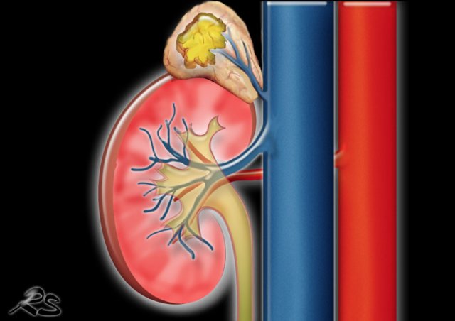 Left Adrenal Gland Adenoma