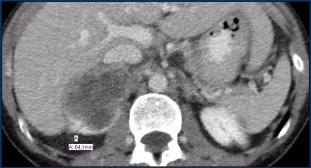 Metastasis of an adenocarcinoma