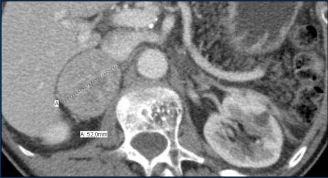 Pheochromocytoma