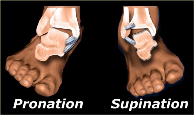 Supination Trauma: Supination of the Foot