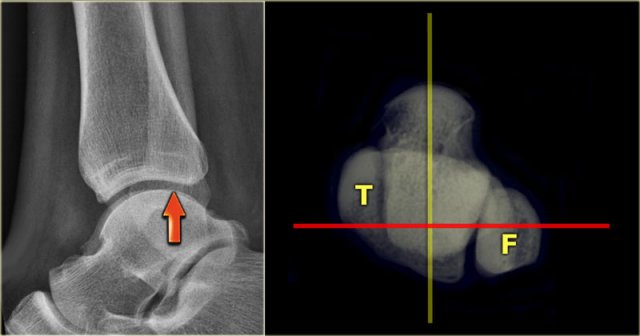 The distal fibula should project on the posterior part of the distal tibia