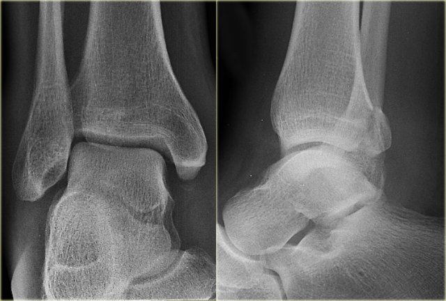 Unstable ankle fracture