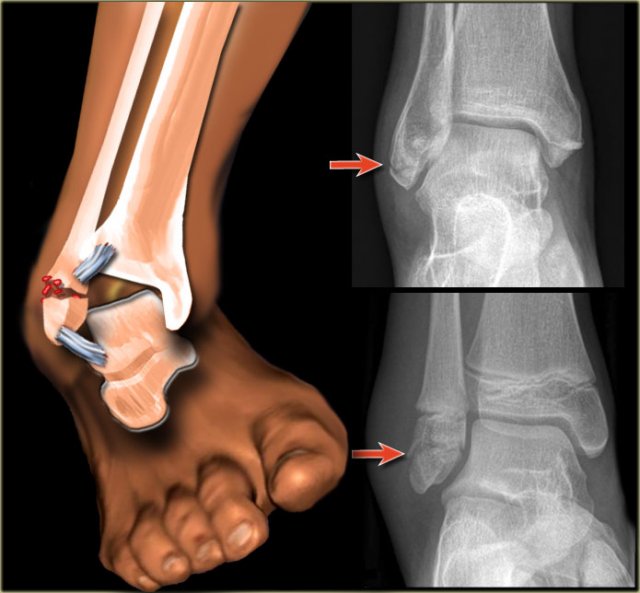 The Radiology Assistant : Ankle fractures - Weber and Lauge-Hansen  Classification